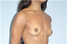 Breast Augmentation Before Photo by Keyian Paydar, MD, FACS; Newport Beach, CA - Case 51536