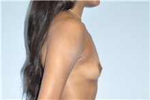 Breast Augmentation Before Photo by Keyian Paydar, MD, FACS; Newport Beach, CA - Case 51536