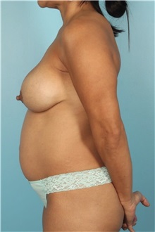 Mommy Makeover Before Photo by Keyian Paydar, MD, FACS; Newport Beach, CA - Case 51607