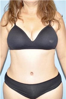 Liposuction After Photo by Keyian Paydar, MD, FACS; Newport Beach, CA - Case 51605