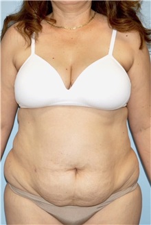 Liposuction Before Photo by Keyian Paydar, MD, FACS; Newport Beach, CA - Case 51605