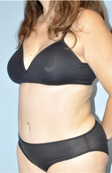 Liposuction After Photo by Keyian Paydar, MD, FACS; Newport Beach, CA - Case 51605