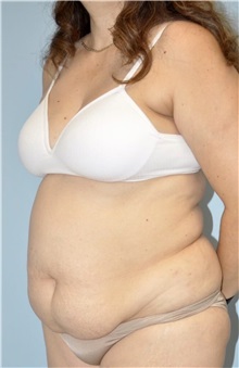 Liposuction Before Photo by Keyian Paydar, MD, FACS; Newport Beach, CA - Case 51605