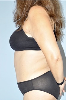 Liposuction After Photo by Keyian Paydar, MD, FACS; Newport Beach, CA - Case 51605