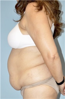 Liposuction Before Photo by Keyian Paydar, MD, FACS; Newport Beach, CA - Case 51605