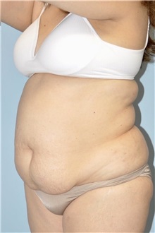 Liposuction Before Photo by Keyian Paydar, MD, FACS; Newport Beach, CA - Case 51605