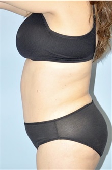 Liposuction After Photo by Keyian Paydar, MD, FACS; Newport Beach, CA - Case 51605