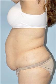 Liposuction Before Photo by Keyian Paydar, MD, FACS; Newport Beach, CA - Case 51605