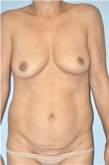 Breast Augmentation Before Photo by Keyian Paydar, MD, FACS; Newport Beach, CA - Case 51611