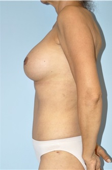 Breast Augmentation After Photo by Keyian Paydar, MD, FACS; Newport Beach, CA - Case 51611