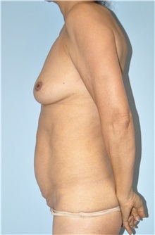 Breast Augmentation Before Photo by Keyian Paydar, MD, FACS; Newport Beach, CA - Case 51611