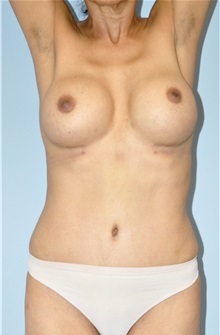 Breast Augmentation After Photo by Keyian Paydar, MD, FACS; Newport Beach, CA - Case 51611