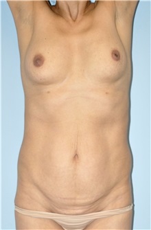 Breast Augmentation Before Photo by Keyian Paydar, MD, FACS; Newport Beach, CA - Case 51611