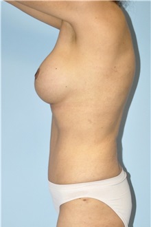 Breast Augmentation After Photo by Keyian Paydar, MD, FACS; Newport Beach, CA - Case 51611