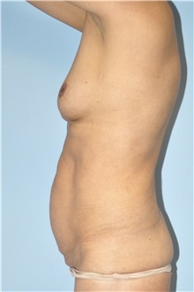 Breast Augmentation Before Photo by Keyian Paydar, MD, FACS; Newport Beach, CA - Case 51611