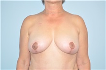 Breast Lift After Photo by Keyian Paydar, MD, FACS; Newport Beach, CA - Case 49592