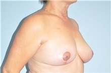 Breast Lift After Photo by Keyian Paydar, MD, FACS; Newport Beach, CA - Case 49592