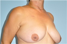 Breast Lift Before Photo by Keyian Paydar, MD, FACS; Newport Beach, CA - Case 49592