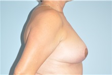 Breast Lift After Photo by Keyian Paydar, MD, FACS; Newport Beach, CA - Case 49592