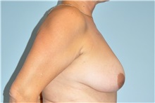 Breast Lift Before Photo by Keyian Paydar, MD, FACS; Newport Beach, CA - Case 49592