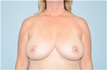 Breast Reduction Before Photo by Keyian Paydar, MD, FACS; Newport Beach, CA - Case 49596