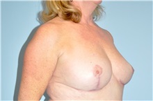 Breast Reduction After Photo by Keyian Paydar, MD, FACS; Newport Beach, CA - Case 49596