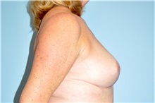 Breast Reduction After Photo by Keyian Paydar, MD, FACS; Newport Beach, CA - Case 49596