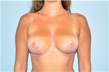 Breast Reduction After Photo by Keyian Paydar, MD, FACS; Newport Beach, CA - Case 49597