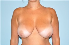 Breast Reduction Before Photo by Keyian Paydar, MD, FACS; Newport Beach, CA - Case 49597