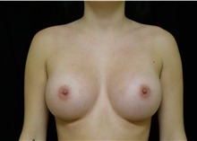 Breast Augmentation After Photo by Russell Babbitt, MD; Fall River, MA - Case 45924