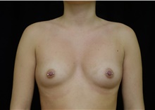 Breast Augmentation Before Photo by Russell Babbitt, MD; Fall River, MA - Case 45924