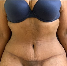 Tummy Tuck After Photo by Russell Babbitt, MD; Fall River, MA - Case 45932