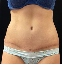 Tummy Tuck After Photo by Russell Babbitt, MD; Fall River, MA - Case 45945