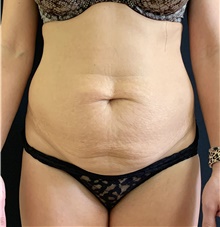 Tummy Tuck Before Photo by Russell Babbitt, MD; Fall River, MA - Case 45945