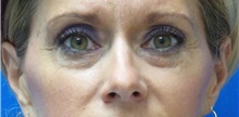 Eyelid Surgery Before Photo by Michael Fallucco, MD, FACS; Jacksonville, FL - Case 30548