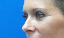 Eyelid Surgery After Photo by Michael Fallucco, MD, FACS; Jacksonville, FL - Case 30548
