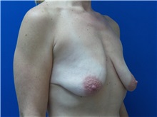 Breast Lift Before Photo by Michael Fallucco, MD, FACS; Jacksonville, FL - Case 30549
