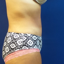 Tummy Tuck After Photo by Michael Fallucco, MD, FACS; Jacksonville, FL - Case 30629