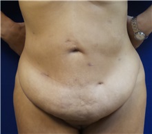 Tummy Tuck Before Photo by Michael Fallucco, MD, FACS; Jacksonville, FL - Case 30629