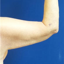 Arm Lift After Photo by Michael Fallucco, MD, FACS; Jacksonville, FL - Case 30634