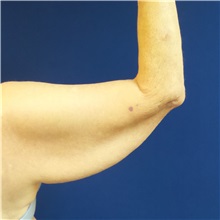 Arm Lift Before Photo by Michael Fallucco, MD, FACS; Jacksonville, FL - Case 30634