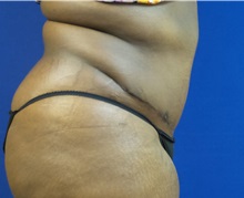 Tummy Tuck After Photo by Michael Fallucco, MD, FACS; Jacksonville, FL - Case 30635