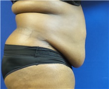 Tummy Tuck Before Photo by Michael Fallucco, MD, FACS; Jacksonville, FL - Case 30635
