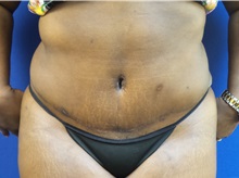 Tummy Tuck After Photo by Michael Fallucco, MD, FACS; Jacksonville, FL - Case 30635