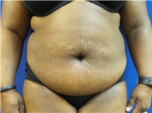 Tummy Tuck Before Photo by Michael Fallucco, MD, FACS; Jacksonville, FL - Case 30635