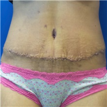Tummy Tuck After Photo by Michael Fallucco, MD, FACS; Jacksonville, FL - Case 30982