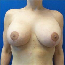 Breast Lift After Photo by Michael Fallucco, MD, FACS; Jacksonville, FL - Case 30987