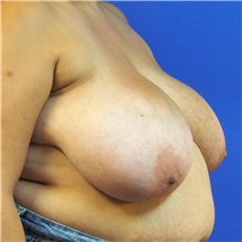 Breast Reduction Before Photo by Michael Fallucco, MD, FACS; Jacksonville, FL - Case 30988