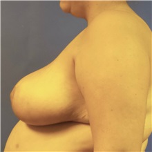 Breast Reduction After Photo by Michael Fallucco, MD, FACS; Jacksonville, FL - Case 30988