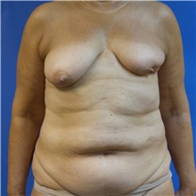 Breast Reconstruction Before Photo by Michael Fallucco, MD, FACS; Jacksonville, FL - Case 30991